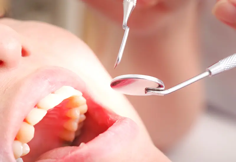 虫歯の治療