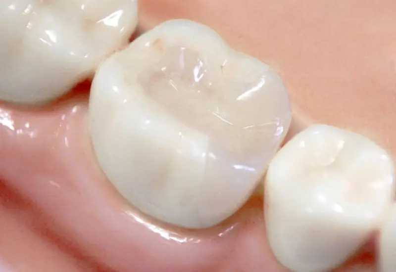 セラミックインレー