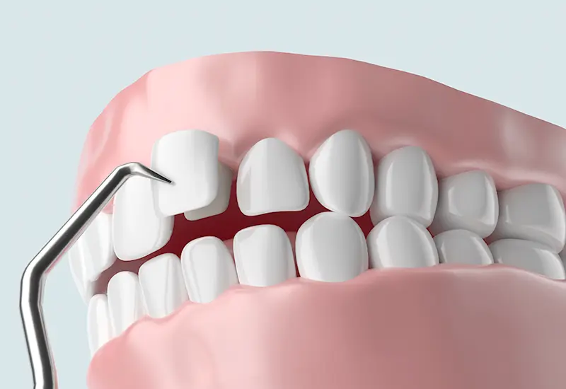 ラミネートベニヤ