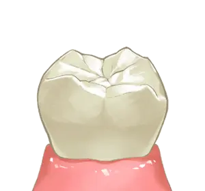 歯の清掃・前処理