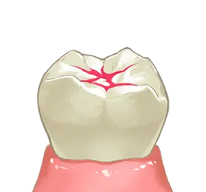 シーラント材の塗布